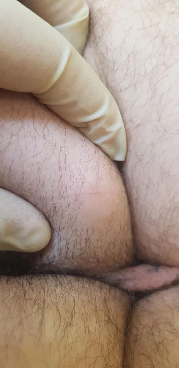 липома Липома