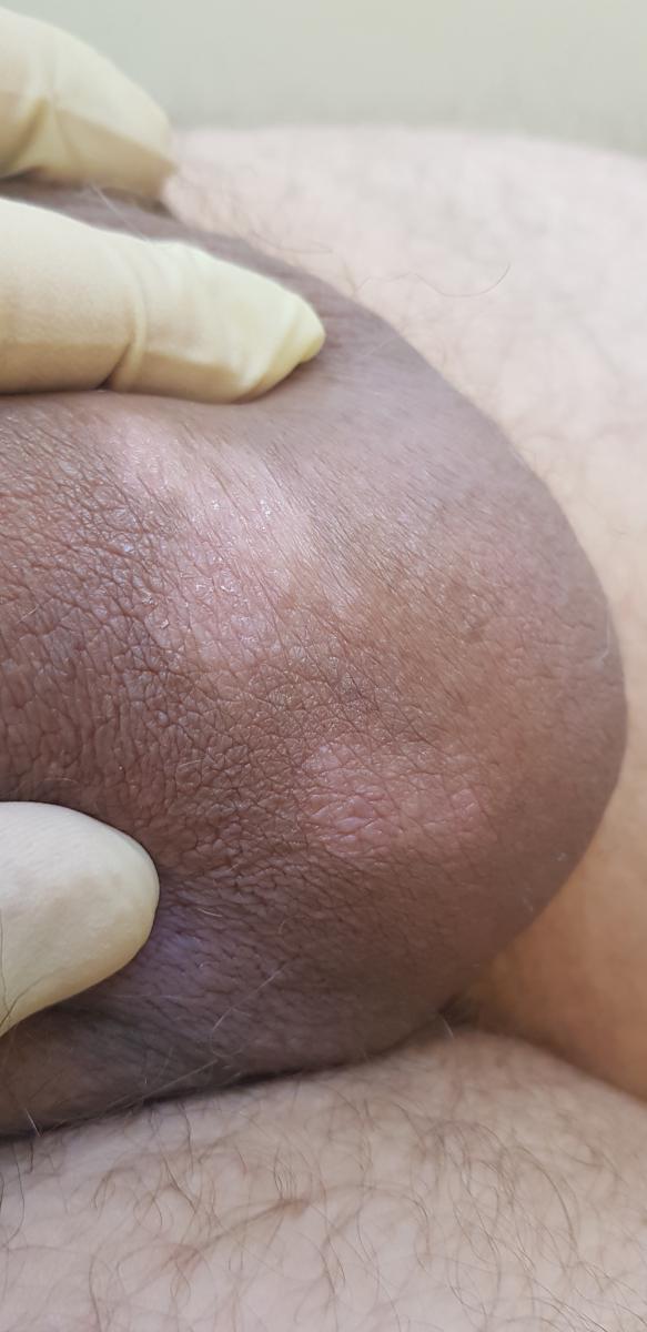 зуд мошонки