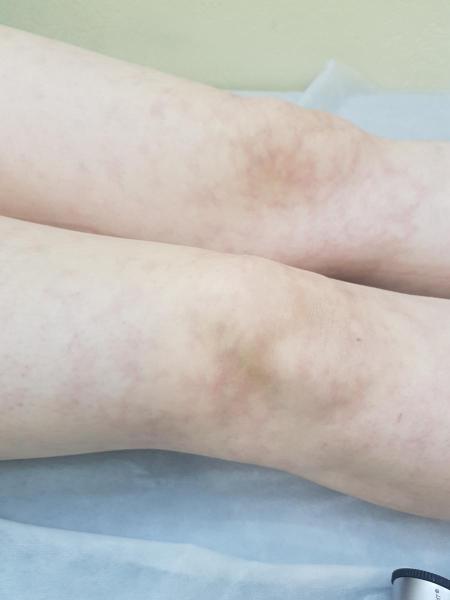 первые симптомы симптомы