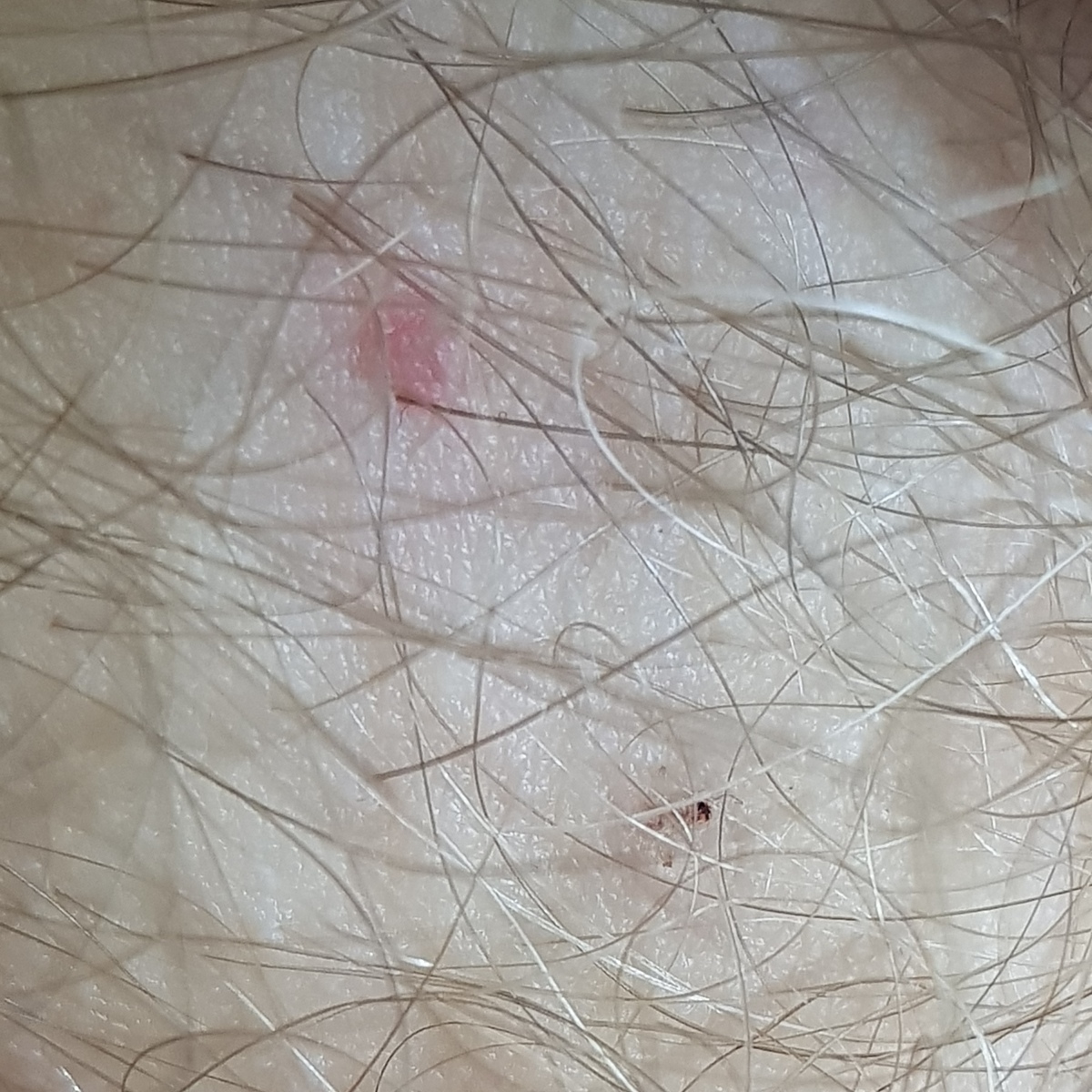 лобковые вши педикулез