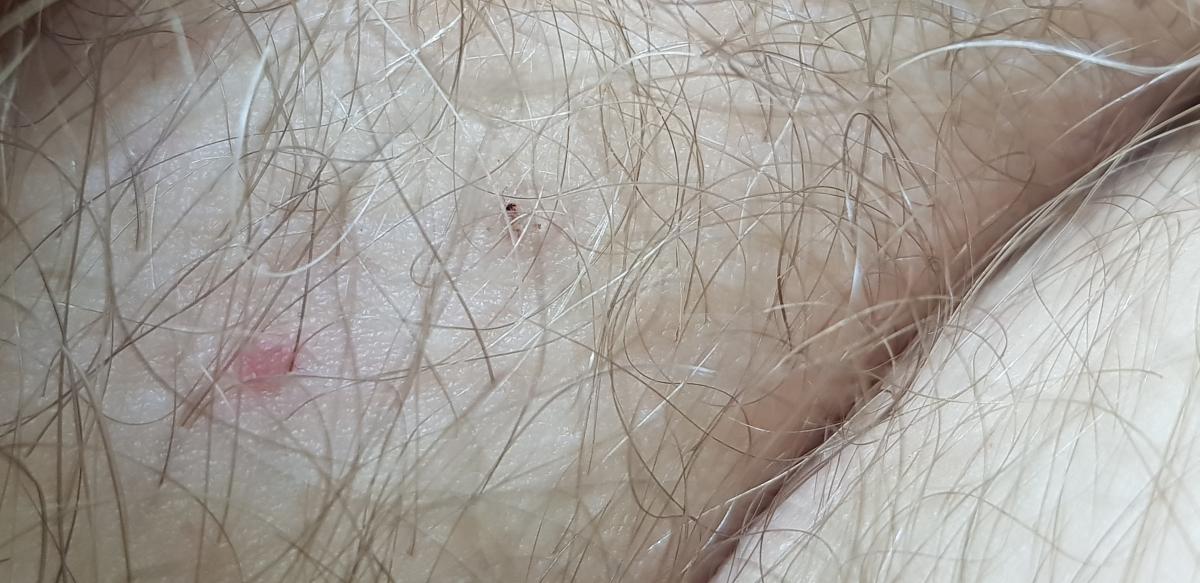 чешется лобок при педикулезе