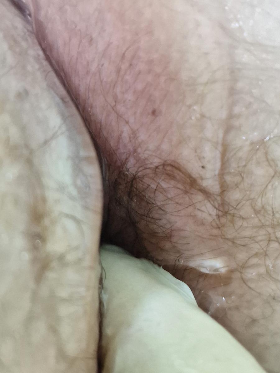 пальцевое исследование прямой кишки пальцевое