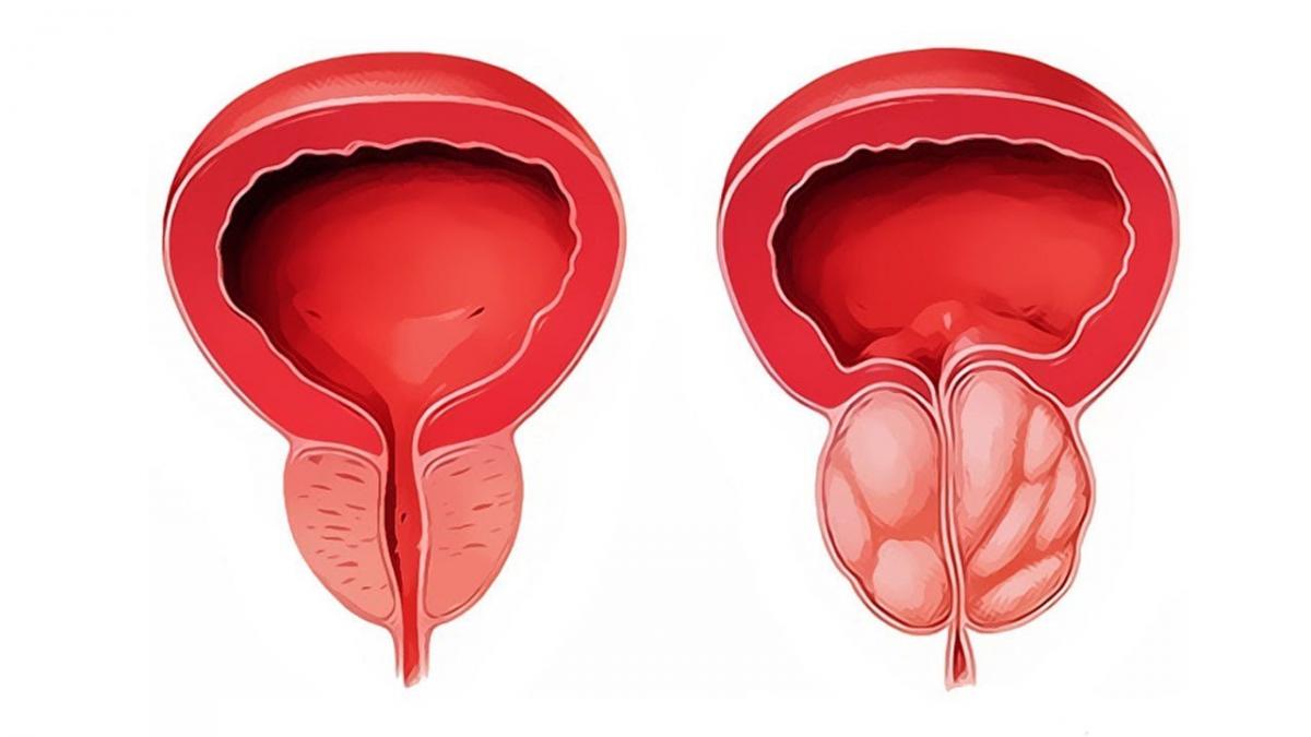 Здоровая простата и простатит