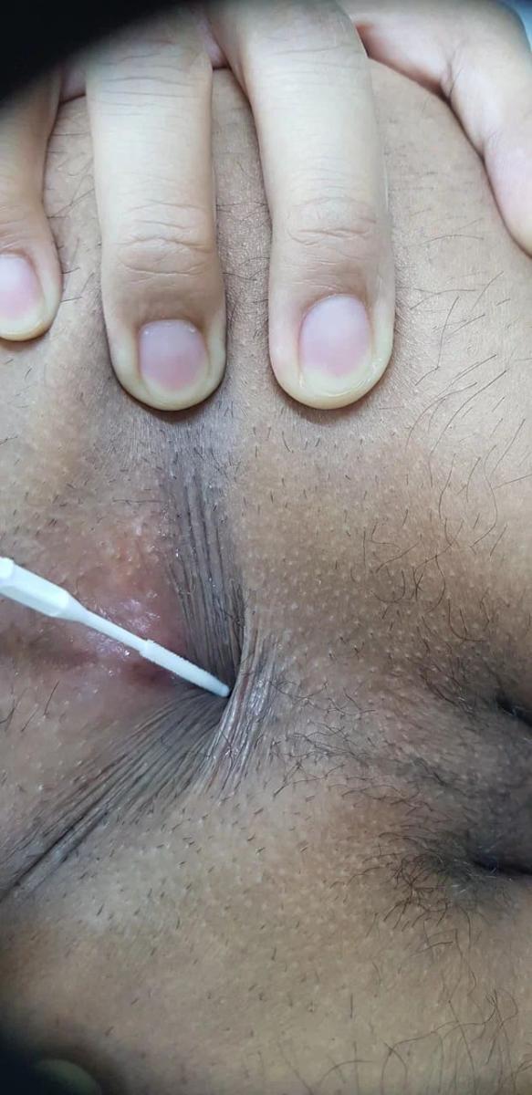 мазок из ануса.