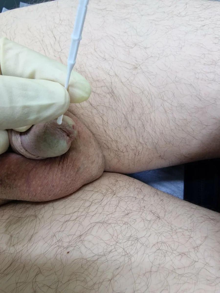 мазок из уретры фдт