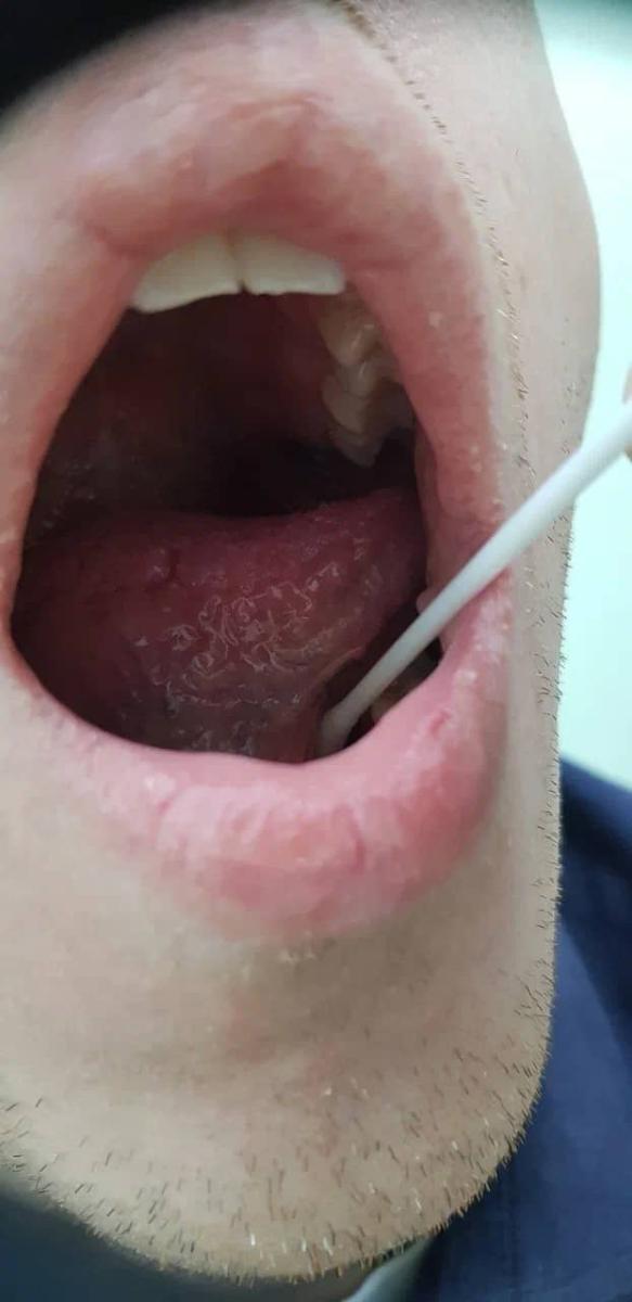 Заразились ИППП мазок изо рта