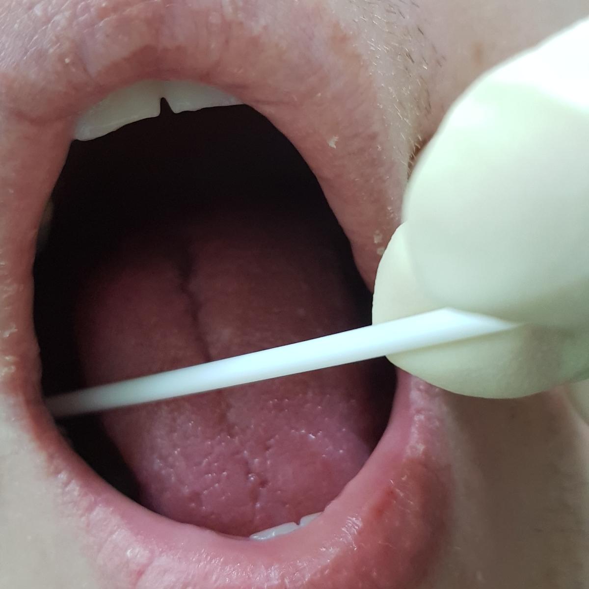 мазок на кандидоз мазок изо рта на кандиду