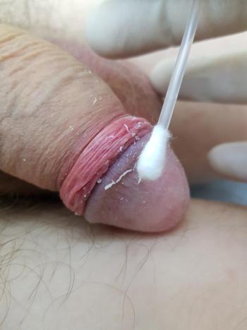 мазок с головки полового члена ВЗЯТИЕ МАЗКОВ
