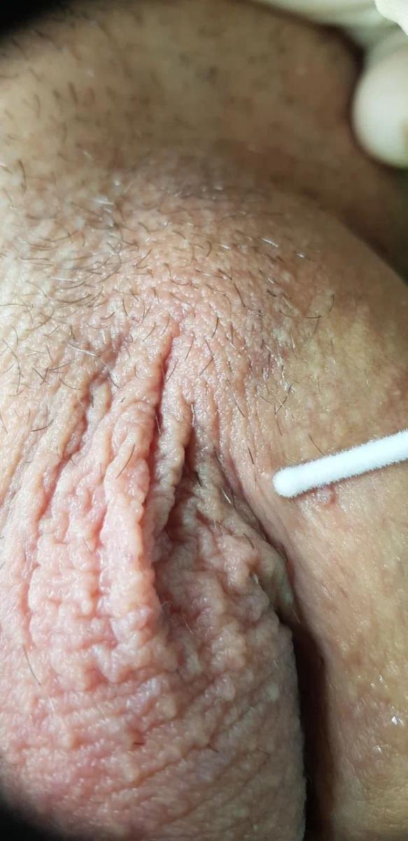 мазок с поверхности кондилом