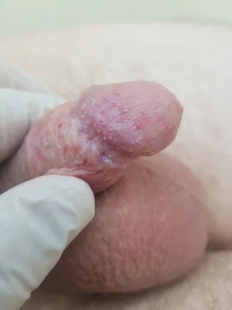 фото мелкие округлые пятна на головке пениса
