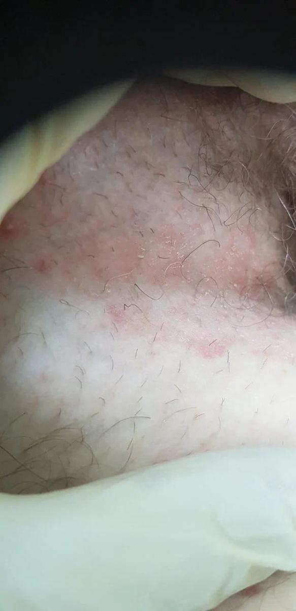 Паховая эпидермофития у женщин