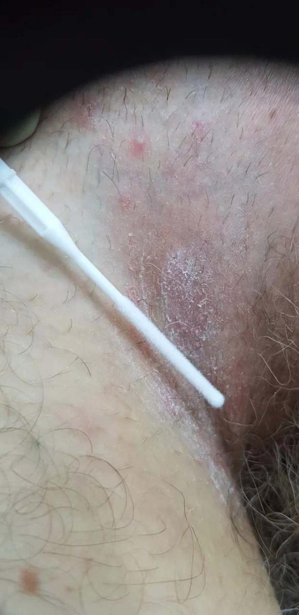 микоз