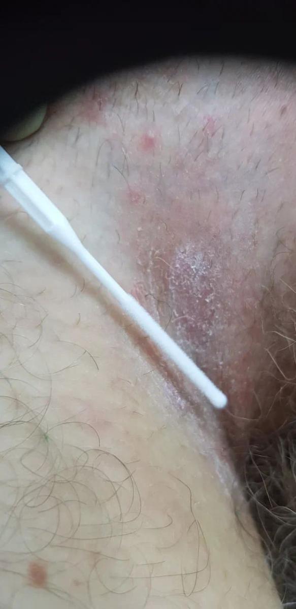 Эритразма Микоз