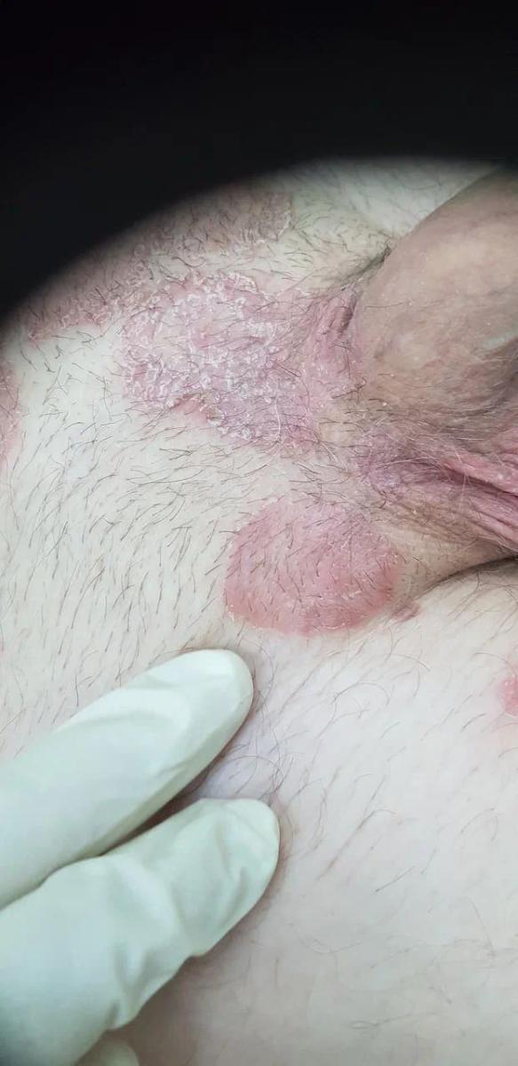 красная сыпь сыпь в области паха