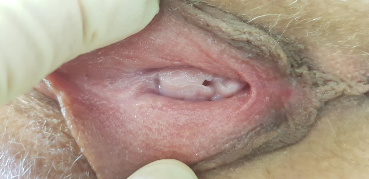 Микропапилломатоз влагалища Микропапилломатоз