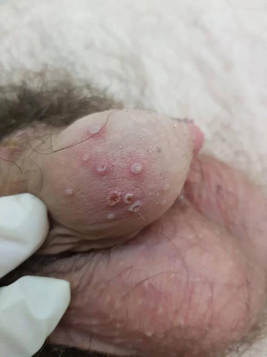 язвочки и эрозии на крайней плоти