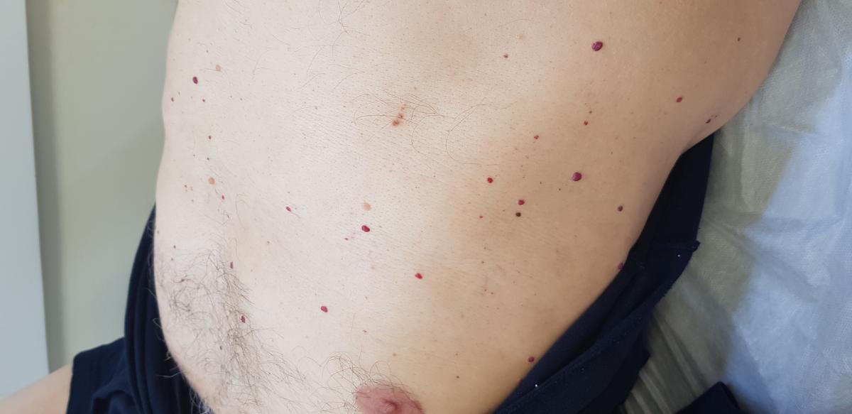 гемангиомы