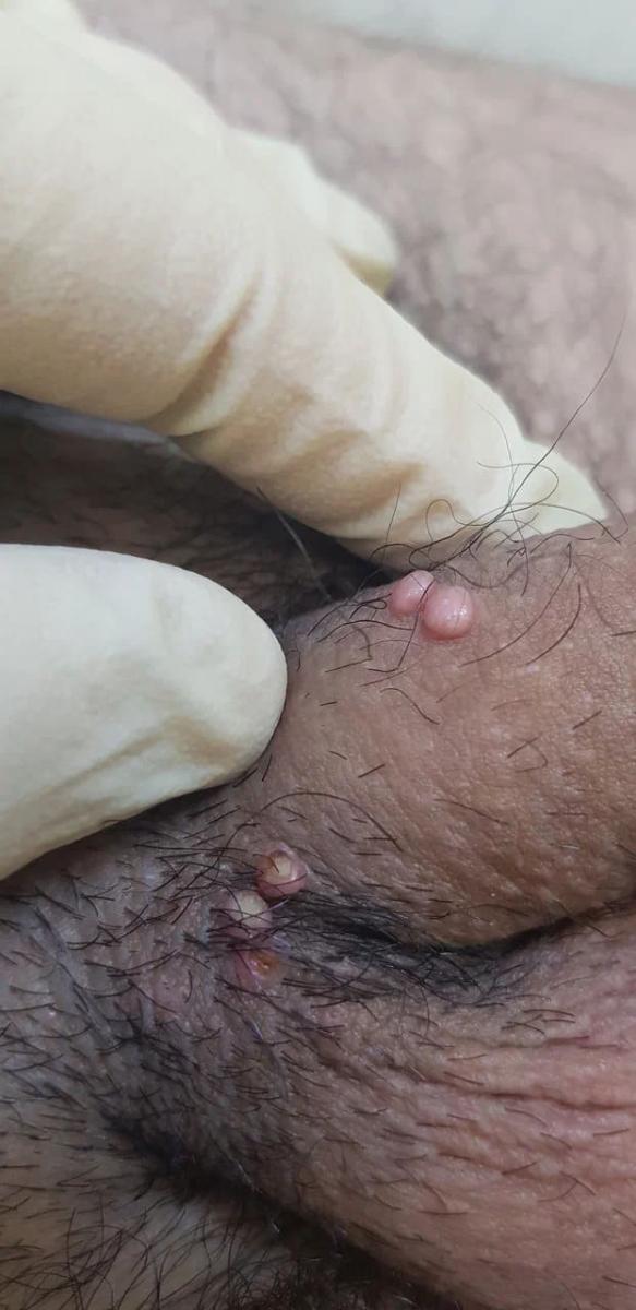 язва на члене