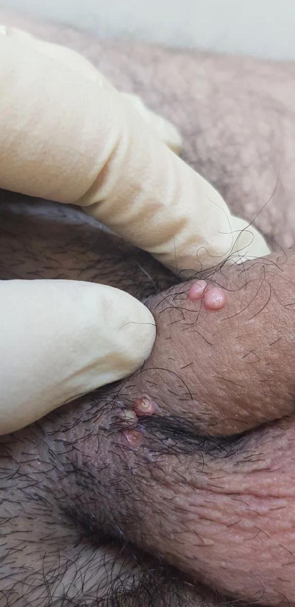 Контагиозный моллюск на половом члене