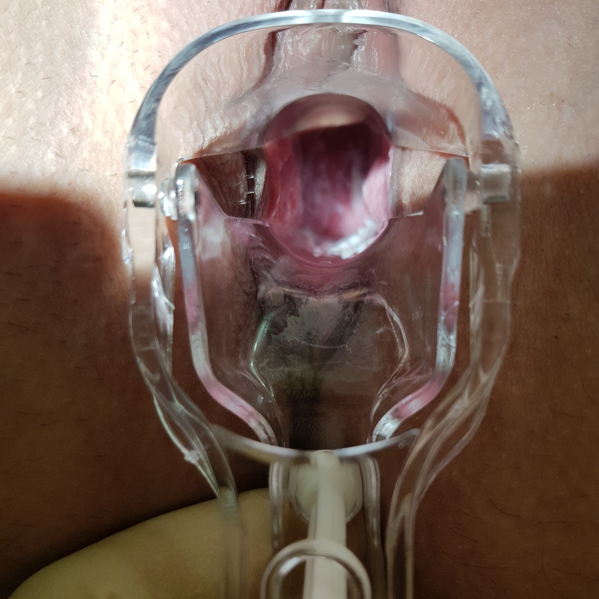 белые выделения из влагалища молочница