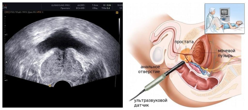 Ультразвуковая диагностика простатита