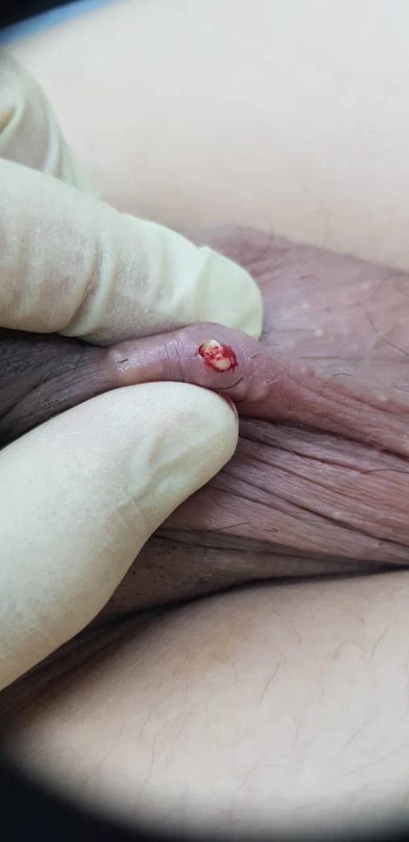 Нагноение Нагноение