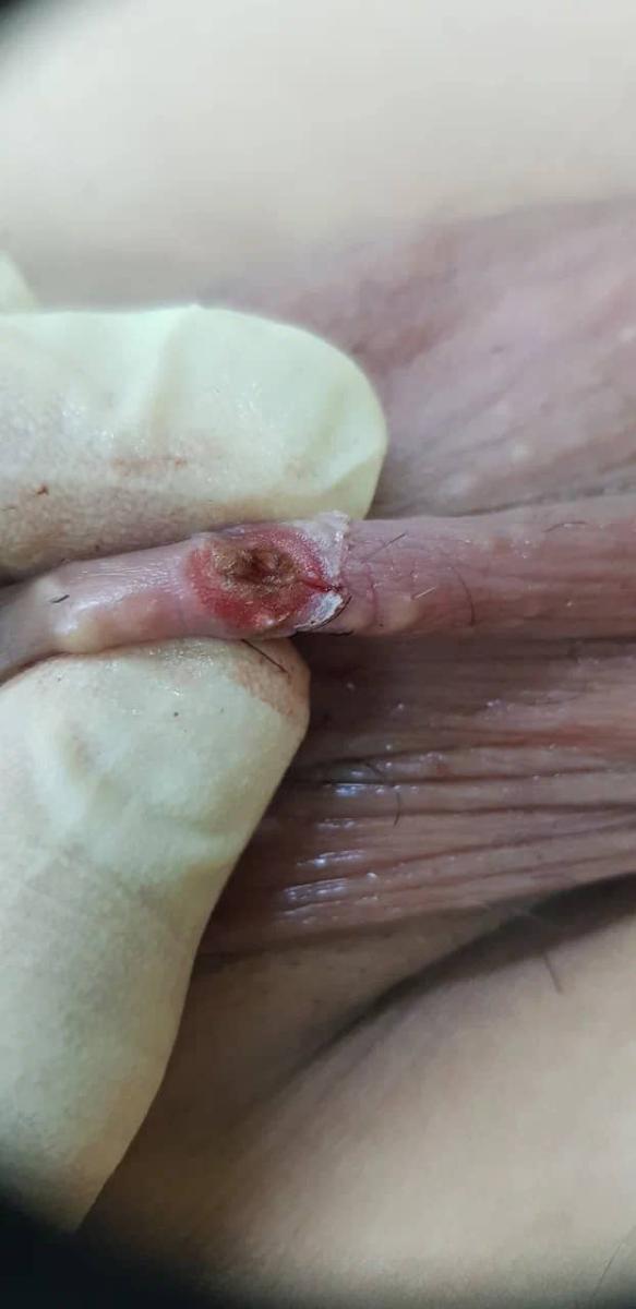 Нагноение Нагноение