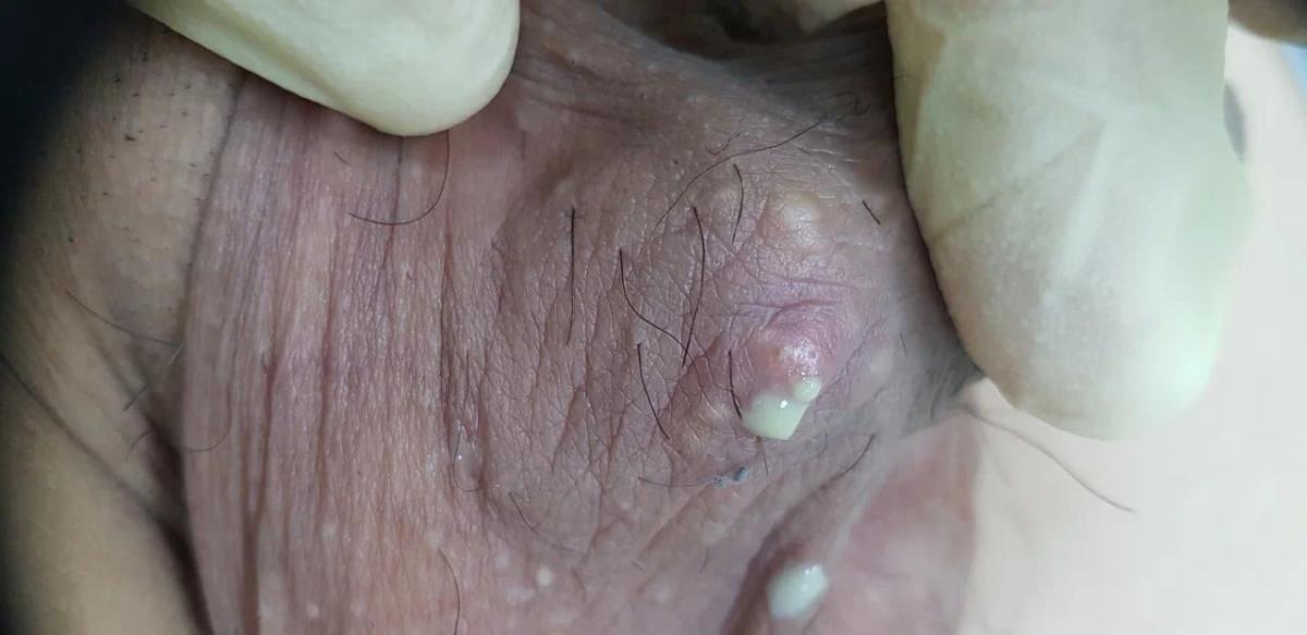 гнойник на коже гнойный процесс