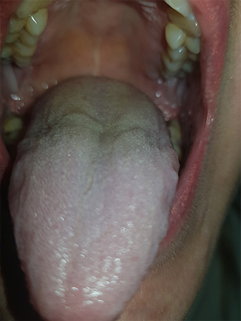 Налет на языке и боли в горле при уреаплазме