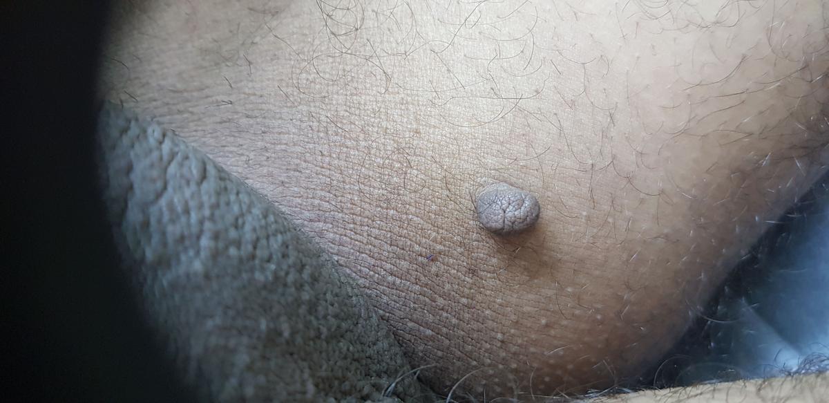 Невус паховой складки