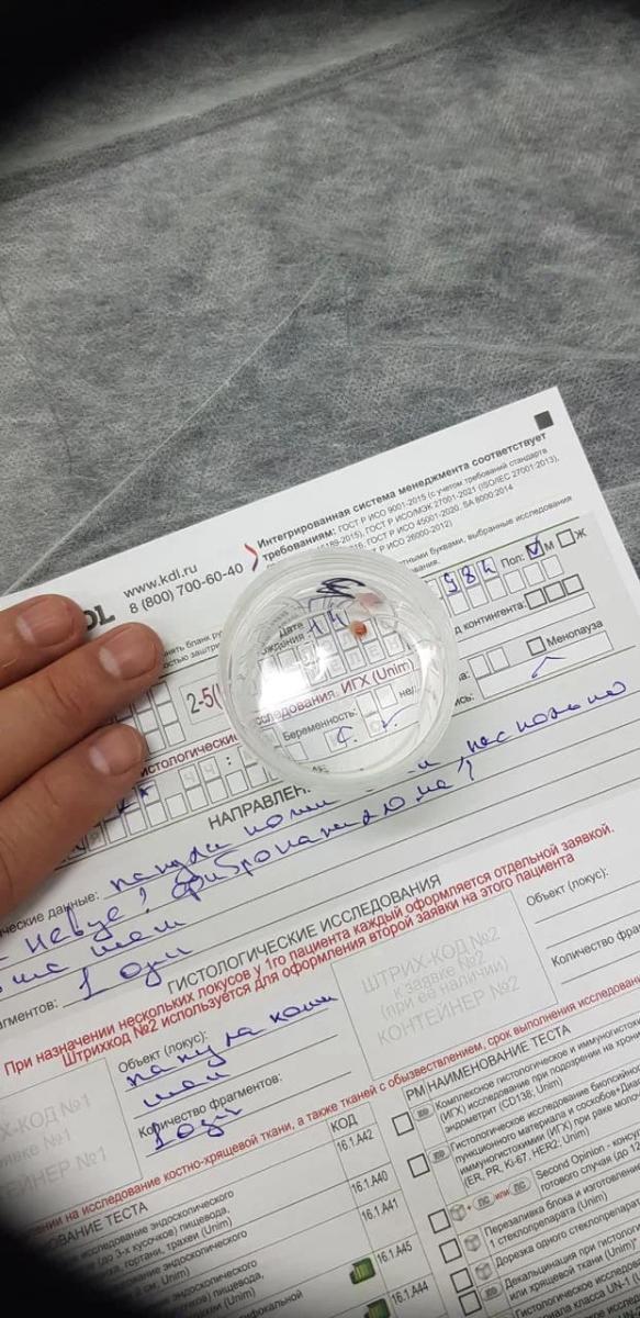 Кондиломы ануса