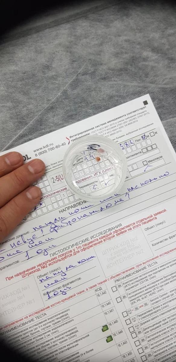 нейрофиброма на шее, с гистологией нейрофиброма на шее, с гистологией