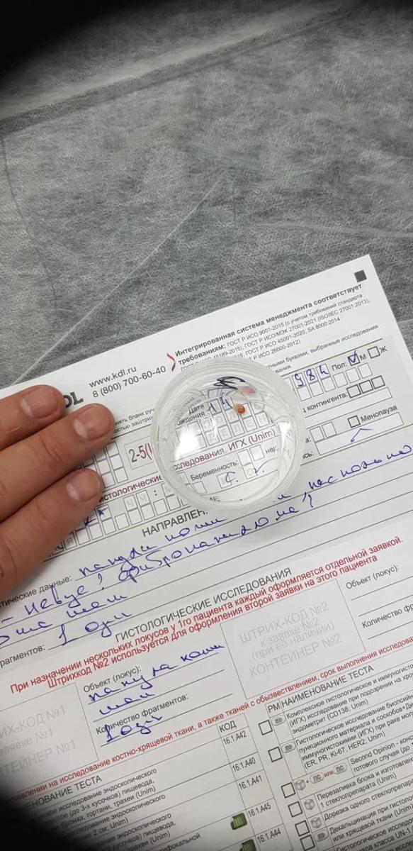 нейрофиброма