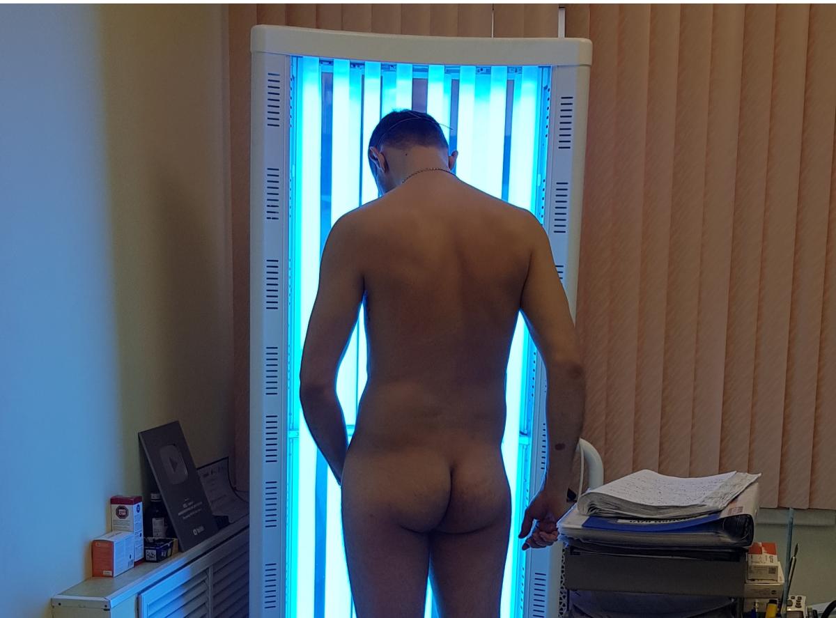 пува терапия