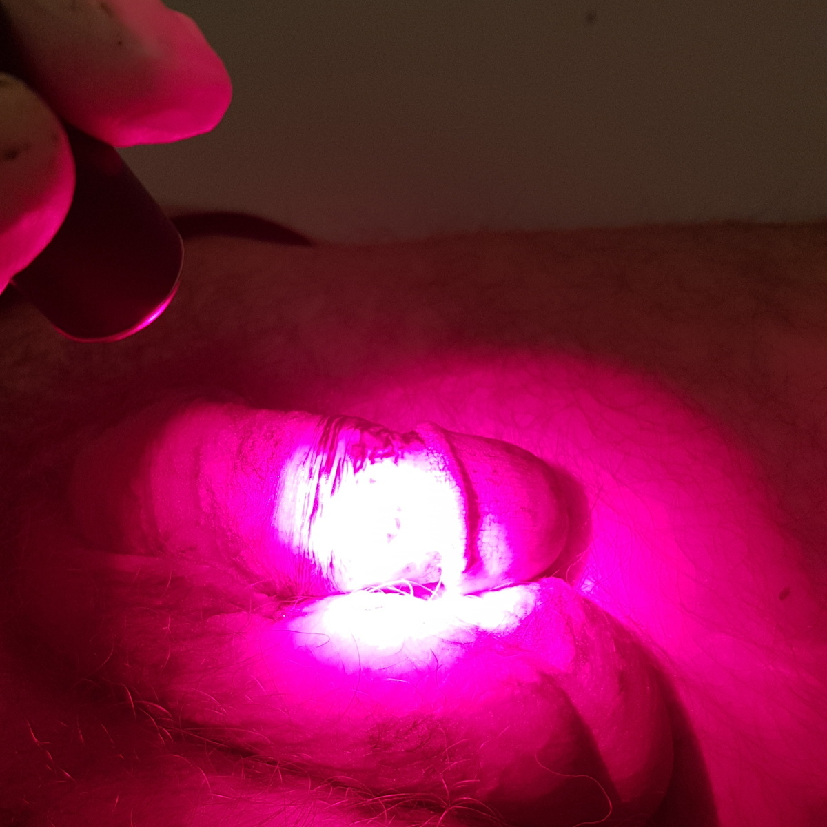 Обработка ревиксаном крайней плоти и фотодинамика обработка ревиксаном