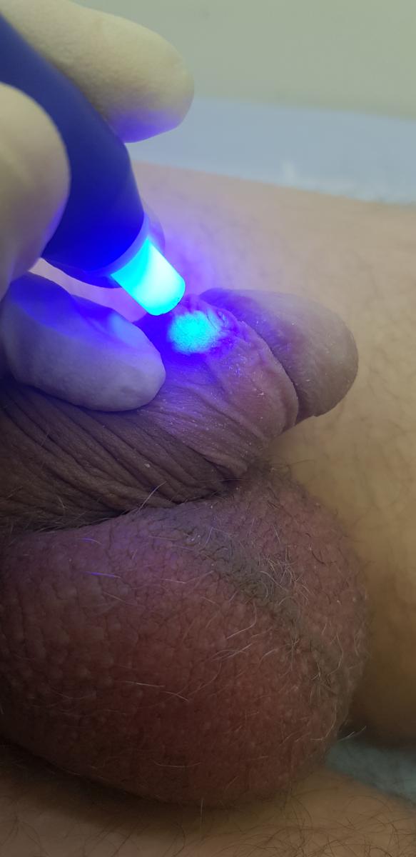 обработка оксидом азота оксид азота