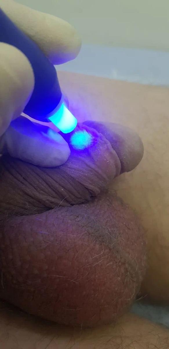 Обработка полового члена оксидом азота