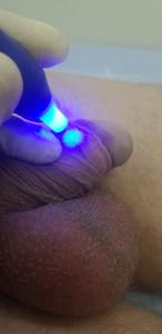 обработка оксидом азота крайней плоти оксид азота