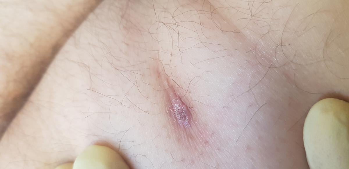 обработка зудящего рубца на ягодице холодной плазмой холодная плазма