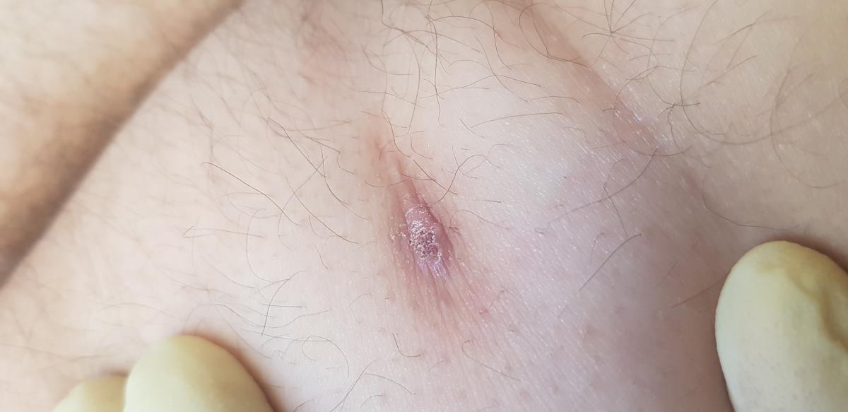 зуд рубца на ягодице зуд рубца