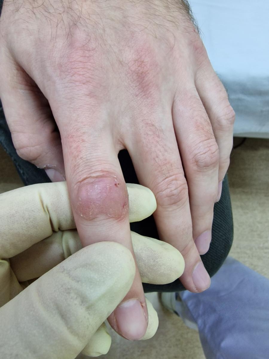 сифилитическая гумма гумма