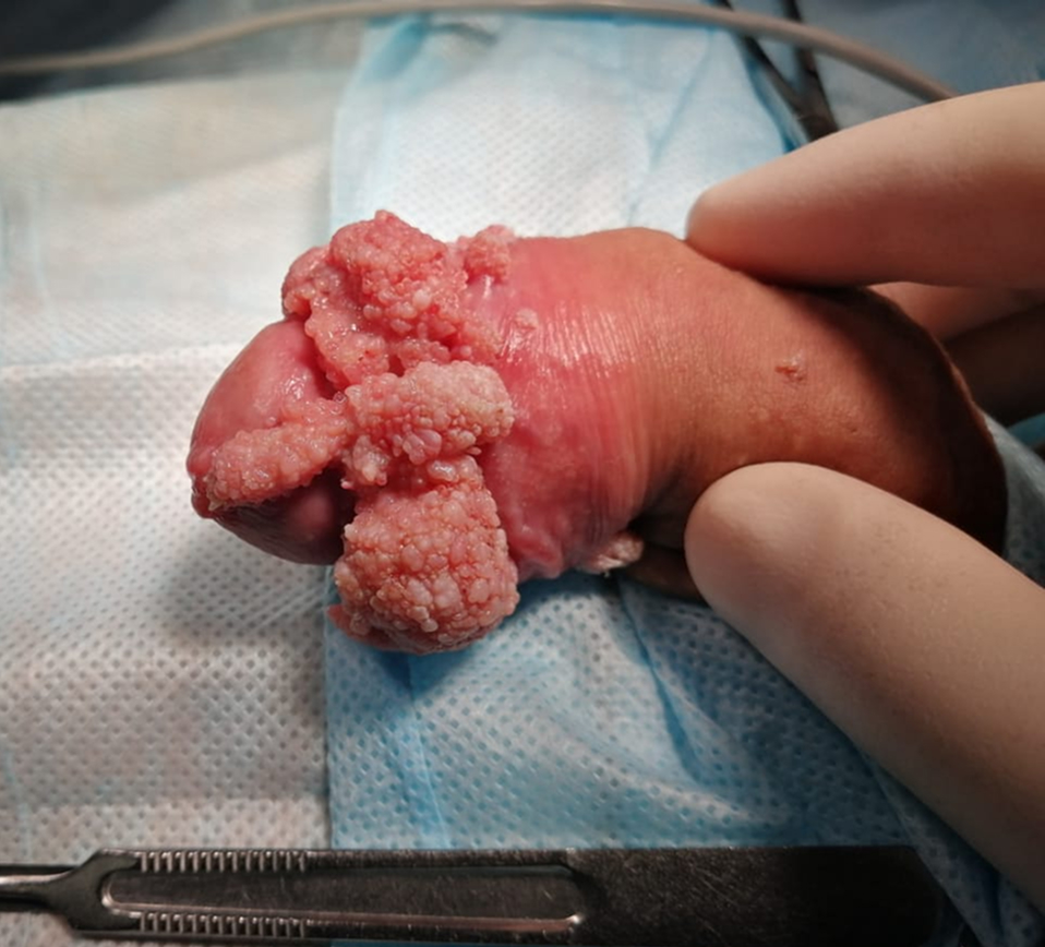 Кондиломы на члене