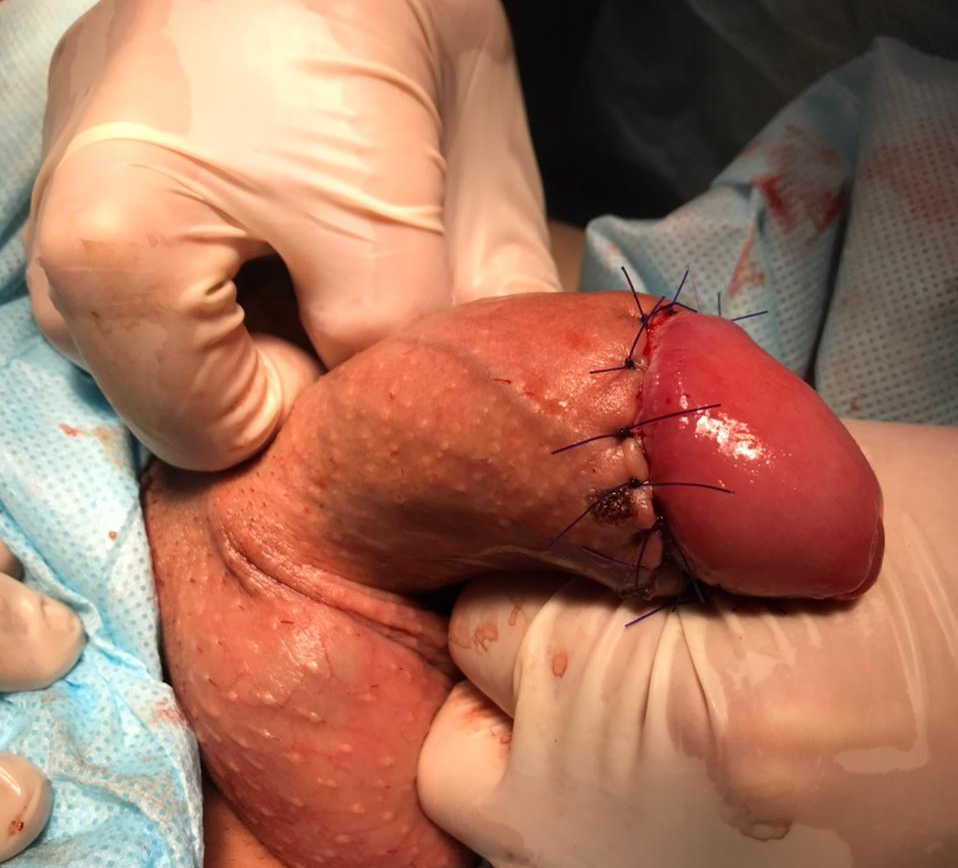 Швы после удаления