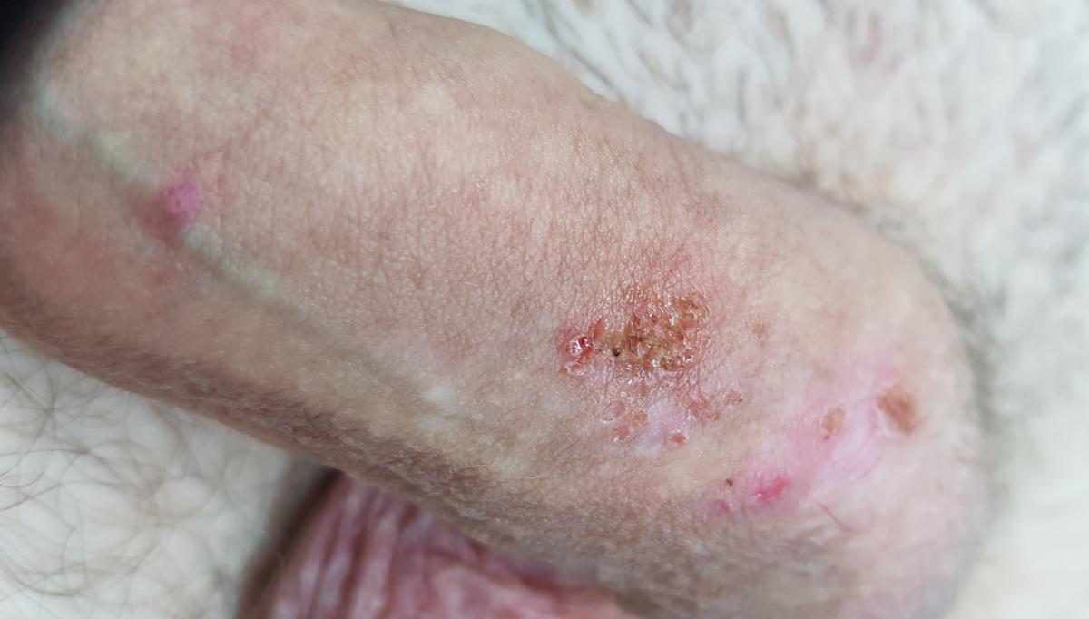 Лечение кондилом