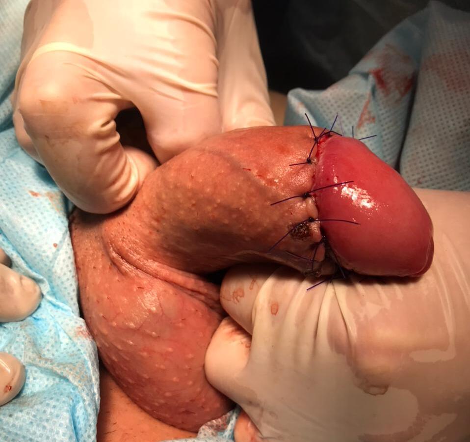 операция на половом члене