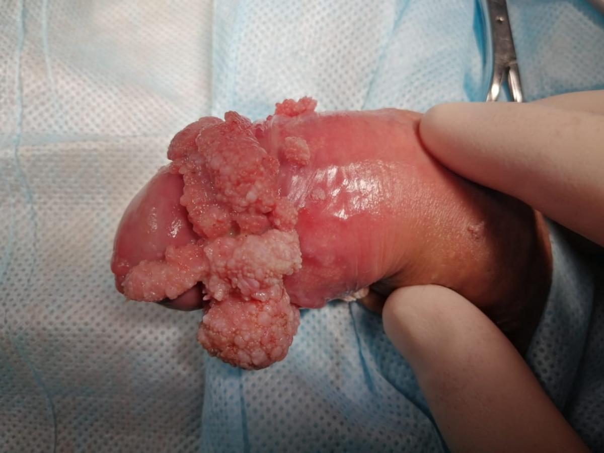 Кондиломы Оперативное удаление кондилом