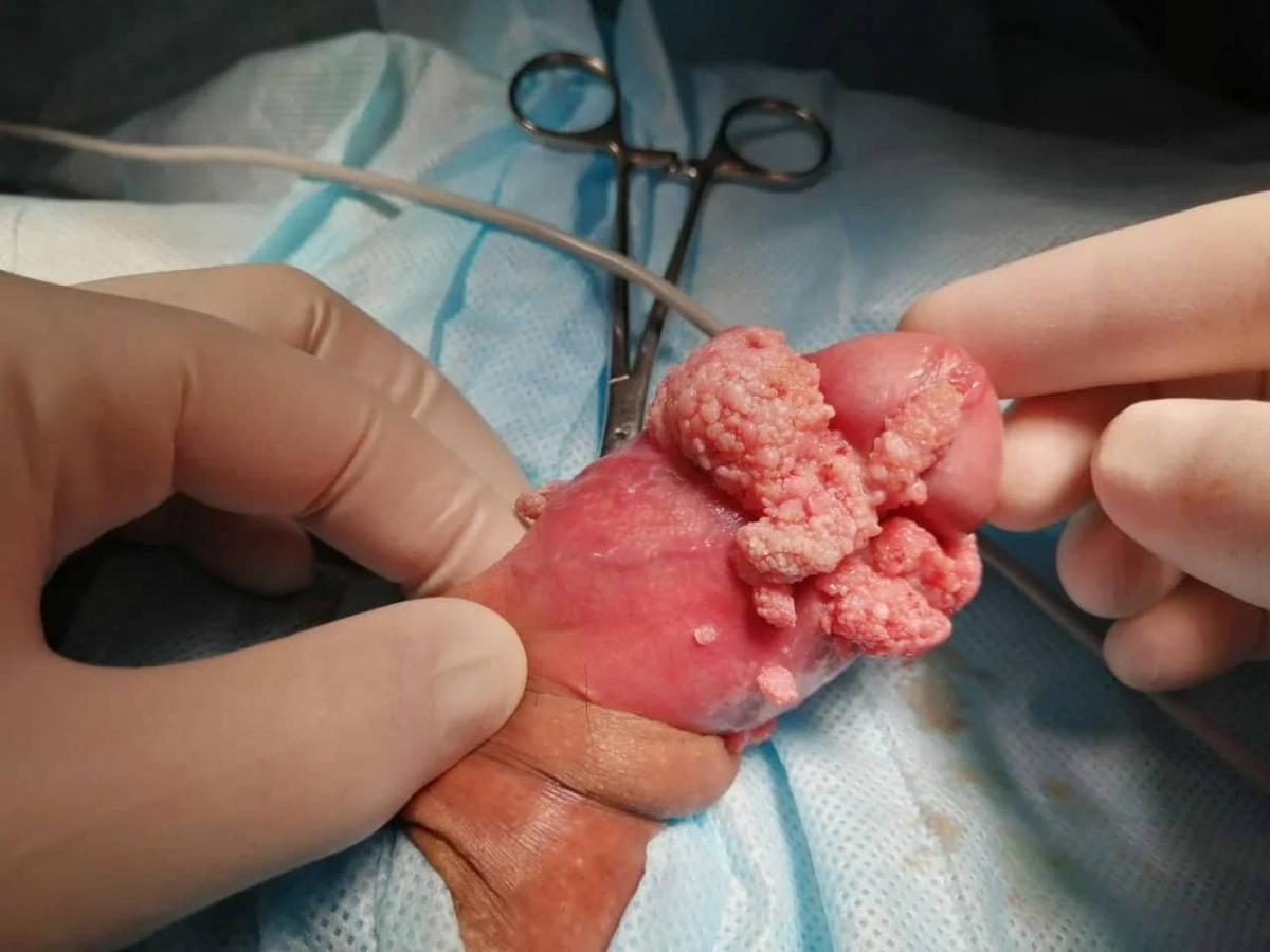 удаление кондилом