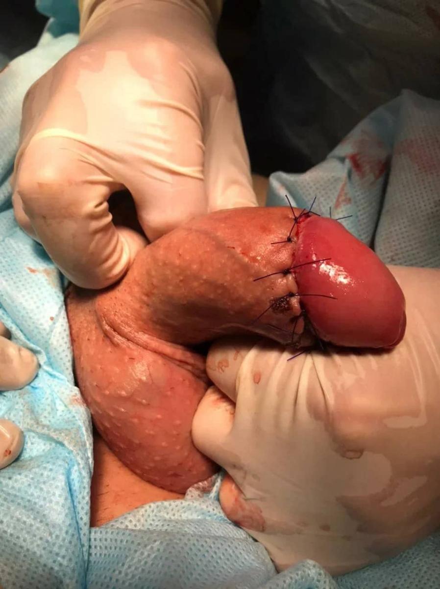 удаление кандилом