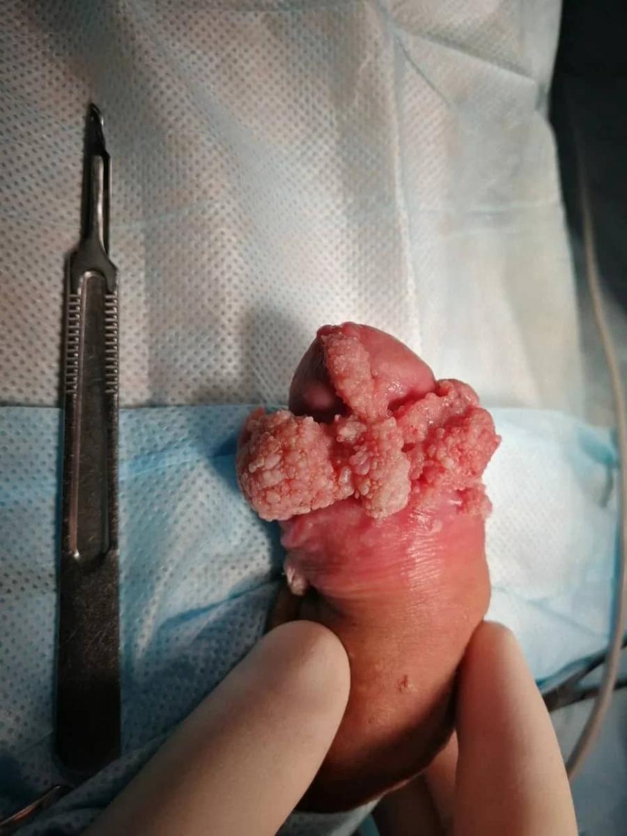 кондилом кондилом