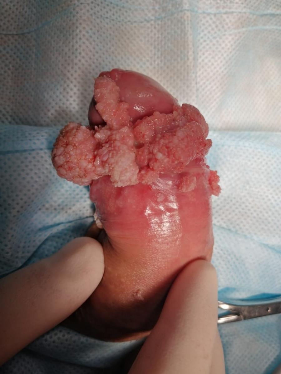 до удаления